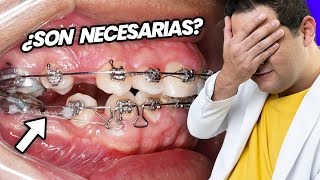 ¡La GUERRA de las EXTRACCIONES de PREMOLARES ¿SACAR DIENTES Es NECESARIO para tu TRATAMIENTO [upl. by Ayekehs]