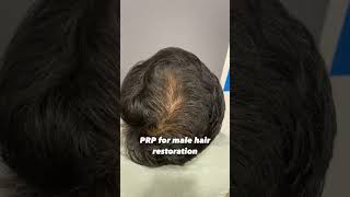 PRP Treatment Results Before and After at Cara clinic Mumbai Prp for hairloss shorts shortsfeed [upl. by Silvester4]