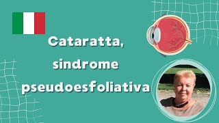 Cataratta sindrome pseudoesfoliativa [upl. by Iretak49]