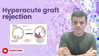 Navigating Hyperacute Graft RejectionKey facts pathology Immunology usmle neetpg [upl. by Leta124]