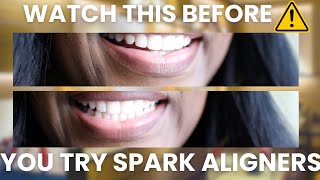 Spark Aligner Rant Watch Before You Get SPARK Aligner [upl. by Salohci]