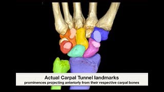 CS Carpal Tunnel Bifid Median Nerve  Sonosite [upl. by Coonan337]