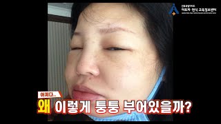 유전성 혈관부종 Hereditary angioedema HAE 이란 증상 유전 검사방법 등 [upl. by Odlamur]