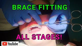 How Braces Are Put On  AMAZING Orthodontist Explained Each Step [upl. by Lauri917]