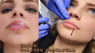 DUDAK DOLGUSU YAPTIRDIM Büşra Pektaş Vlog [upl. by Anerres691]