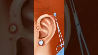 ASMR ear piercing removal Treatment clean ear piercing amp pus 2d animation [upl. by Tibbitts391]