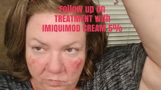 Follow up on Treatment with IMIQUIMOD CREAM 5 [upl. by Curren]