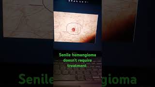 Senile hemangioma does not require treatment senilehemangiomacherryangioma [upl. by Nedak]