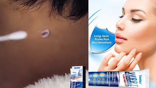 Instant Blemish Removal Gel  Sumifun Wart Remover [upl. by Reis]