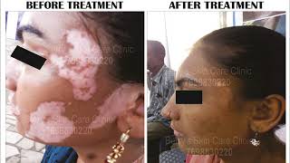 Leucoderma Treatment in India  Berry Skin Care [upl. by Yrohcaz]