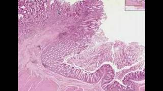 Histopathology ColonAdenocarcinoma [upl. by Nylasoj]