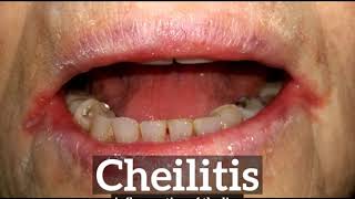 What is Cheilitis  How to Say Cheilitis in English  How Does Cheilitis Look [upl. by Kerri]