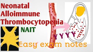 Neonatal Alloimmune thrombocytopenia NAIT in hindi and urdu [upl. by Aynodal908]