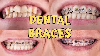 Braces time lapse  Teeth braces treatment  braces teeth transformation [upl. by Ramor688]