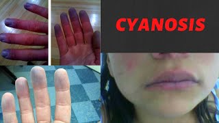 CYANOSIS  Causes Symptoms Types Treatment I What is cyanosis Peripheral and Central Cyanosis [upl. by Edris663]