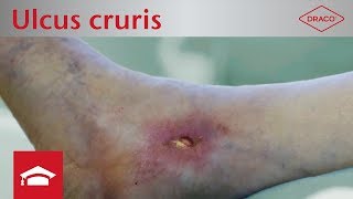 Ulcus cruris venosum und arteriosum Definition Entstehung amp Wundbeschreibung [upl. by Lewej]