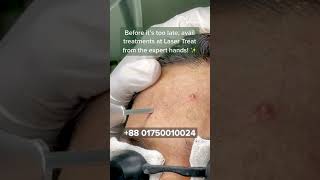 Acne Treatment  Dhaka Dermatology Institute  LaserTreat [upl. by Ilam]