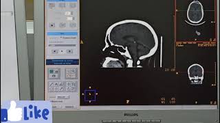 cómo reconstruir una tomografía de cráneo simple en corte axial coronal sagital y 3D [upl. by Yelrihs]