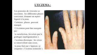 MEDECINE DU TRAVAIL CAT devant une dermatose professionnelle Dermite de contact [upl. by Aiouqes85]