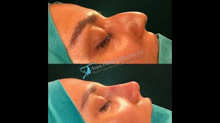 Aquiline Nose Rhinoplasty [upl. by Madelin]