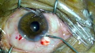 cataract with posterior synechiae [upl. by Marcelia]