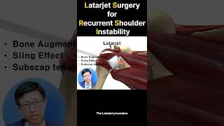 Latarjet Surgery For Shoulder Instability One Last Chance [upl. by Jacintha]