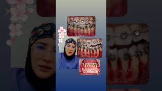 Periodontally accelerated osteogenic orthodontics or PAOO [upl. by Chloris]