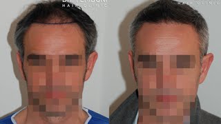 Haartransplantation mit FUE 2000 Grafts [upl. by Etteoj911]