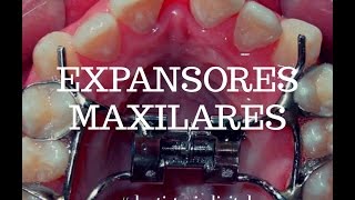 BRACKETS  EXPANSORES MAXILARES  Hyrax  QuadHelix  McNamara [upl. by Oppen]