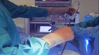 Laparoscopic Hysterectomy [upl. by Samal]