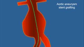 Stent Graft for Aneurysm [upl. by Horodko316]