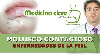 Enfermedades piel Molusco contagioso pápulas perladas granos en niños [upl. by Kwapong]