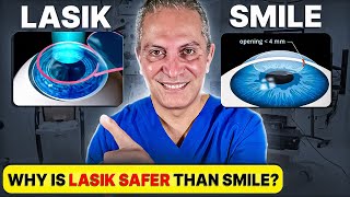 Should you Choose LASIK or SMILE Eye Surgery Eye Surgeon Explains [upl. by Rtoip]