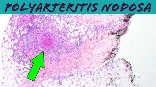 Polyarteritis Nodosa vasculitis pathology dermpath dermatology usmle dermatopathology [upl. by Arytahs946]