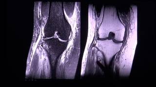 Anterior cruciate ligament tear in MR imaging by RadiologieTV [upl. by Esille]