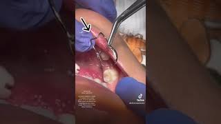 Baby tooth dental Abscess and Band and Loop space maintainer [upl. by Zantos591]