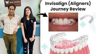 Invisalign Aligners Journey Before and After Review  Invisible Braces  Dental Aesthetics [upl. by Shaughnessy]