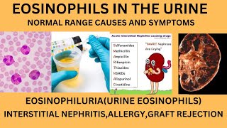 EOSINOPHILS IN URINENORMAL RANGE CAUSES OF EOSINOPHILS IN URINELYMPHOCYTES MONOCYTES IN URINE [upl. by Alfonse]