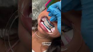 teeth whitening process 🦷 teethwhitening torontoteethwhitening [upl. by Minna]