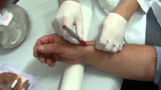 UltrasoundGuided Corticosteroid Injection for the Treatment of de Quervains Tenosynovitis [upl. by Ilah]