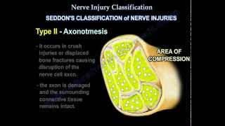 Nerve Injury types  Nerve recovery  Everything You Need To Know  Dr Nabil Ebraheim [upl. by Gnuy]