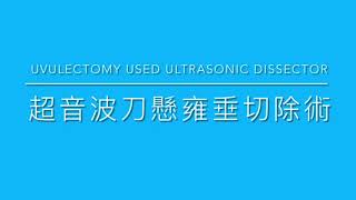 Uvulectomy by cordless ultrasonic dissector under local anesthesia for snoring局部麻醉下超音波刀應用於打呼病患懸雍垂切除 [upl. by Adao]