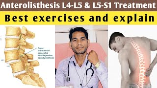 anterolisthesis l5 s1 treatment anterolisthesis grade 1 treatment exercises l4 l5 lumbar spine [upl. by Avram357]