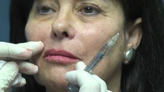 Juvederm Lip Augmentation in Fort Lauderdale [upl. by Merilee]