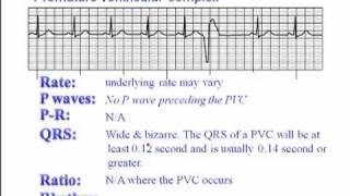 ECG Premature Ventricular Complexes PVC [upl. by Cassady244]