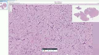 Rosenthal fibers in Pilocytic Astrocytoma  Adventures in Neuropathology [upl. by Biebel]