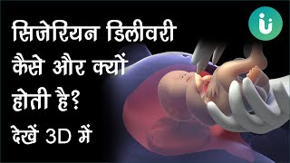 Csection सिजेरियन डिलीवरी क्यों और कैसे की जाती है देखें 3D में  Cesarean delivery in Hindi [upl. by Sinoda575]