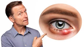 What Really Causes Styes and How to Get Rid of Them Fast [upl. by Arie]