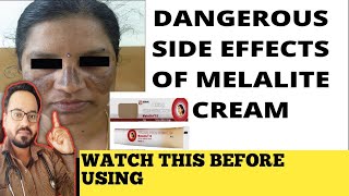 Melalite Cream Review  इस क्रीम का इस्तेमाल ना करें [upl. by Giardap871]