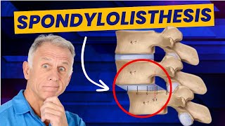 Spondylolisthesis 4 Exercises to Reduce Pain Demo on Real Patient [upl. by Landre131]